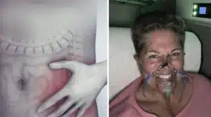 Perheenäiti varoittaa sivuutetusta oireesta, joka kätki suolistosyövän Perheenäiti varoittaa sivuutetusta oireesta, joka kätki suolistosyövän