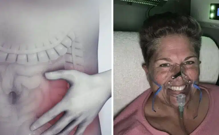 Perheenäiti varoittaa sivuutetusta oireesta, joka kätki suolistosyövän